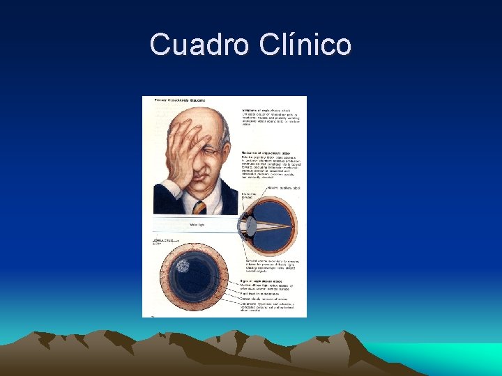Cuadro Clínico Cuadro Clínico
