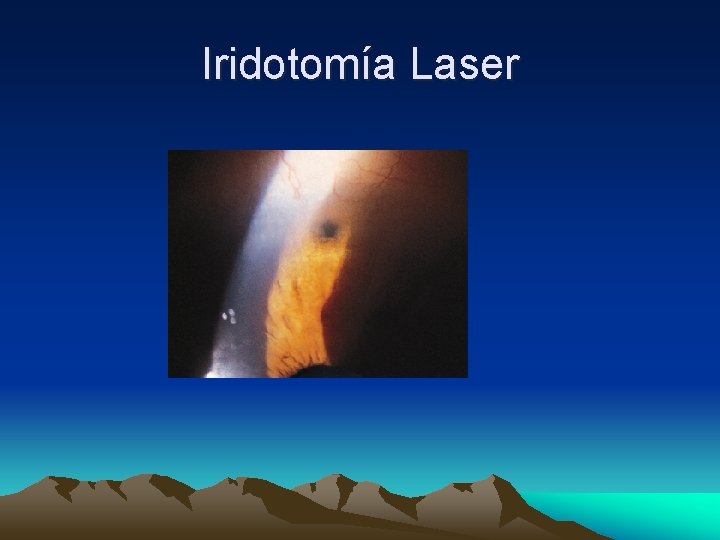 Iridotomía Laser Iridotomía Laser