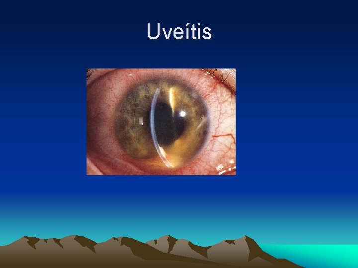 Uveítis Uveítis