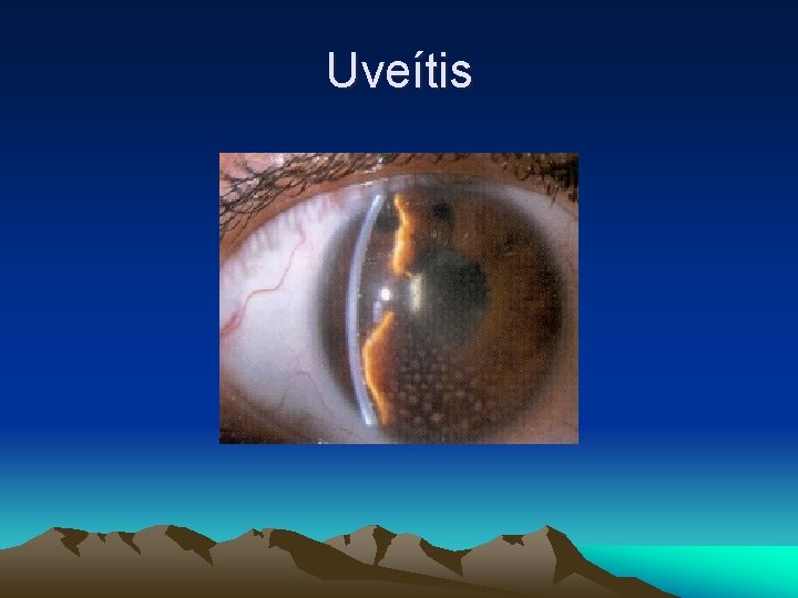 Uveítis Uveítis