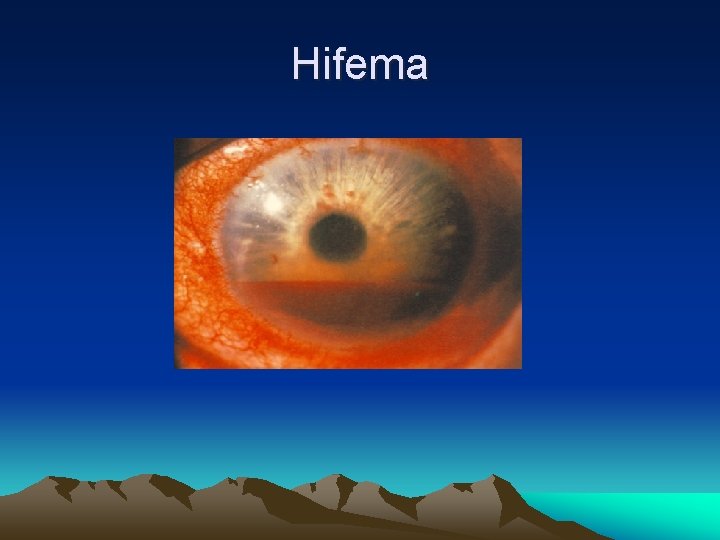 Hifema Hifema