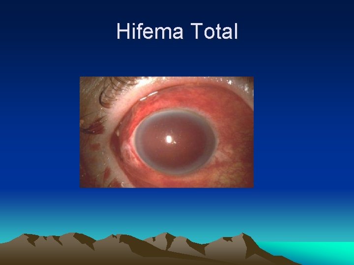 Hifema Total Hifema Total