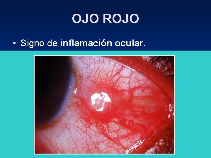 OJO ROJO • Signo de inflamación ocular. • Se aplica a un gran número OJO ROJO • Signo de inflamación ocular. • Se aplica a un gran número