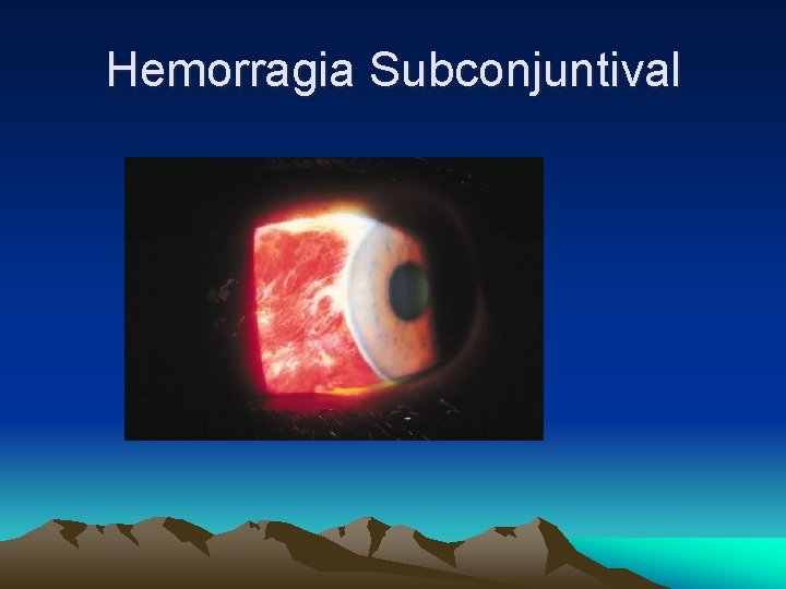 Hemorragia Subconjuntival Hemorragia Subconjuntival
