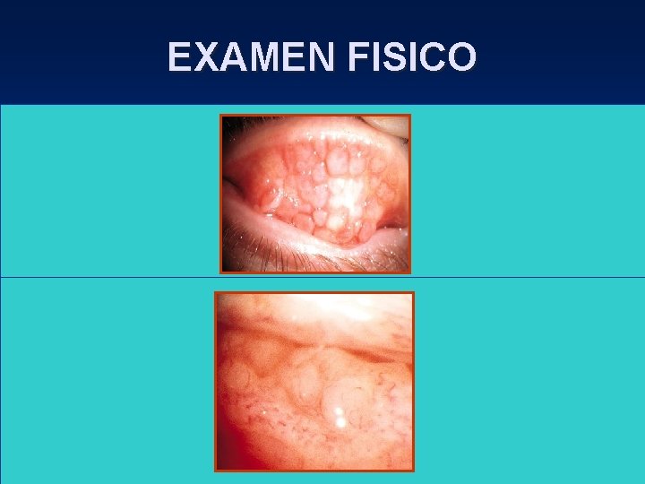 EXAMEN FISICO • Folículos : Reacción aguda ( H. V. , conj. Inclusión, Q. EXAMEN FISICO • Folículos : Reacción aguda ( H. V. , conj. Inclusión, Q.