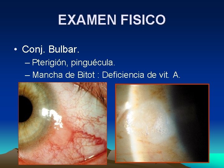 EXAMEN FISICO • Conj. Bulbar. – Pterigión, pinguécula. – Mancha de Bitot : Deficiencia EXAMEN FISICO • Conj. Bulbar. – Pterigión, pinguécula. – Mancha de Bitot : Deficiencia
