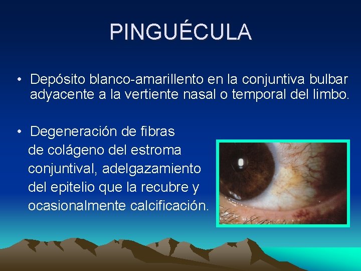PINGUÉCULA • Depósito blanco-amarillento en la conjuntiva bulbar adyacente a la vertiente nasal o PINGUÉCULA • Depósito blanco-amarillento en la conjuntiva bulbar adyacente a la vertiente nasal o