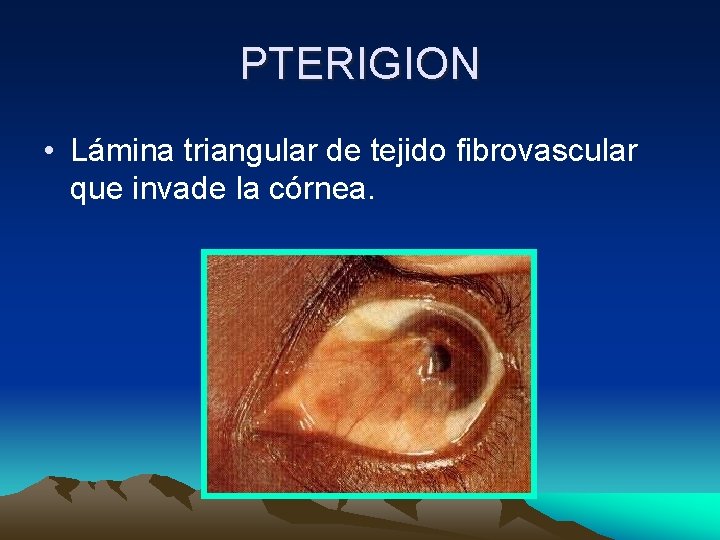 PTERIGION • Lámina triangular de tejido fibrovascular que invade la córnea. PTERIGION • Lámina triangular de tejido fibrovascular que invade la córnea.