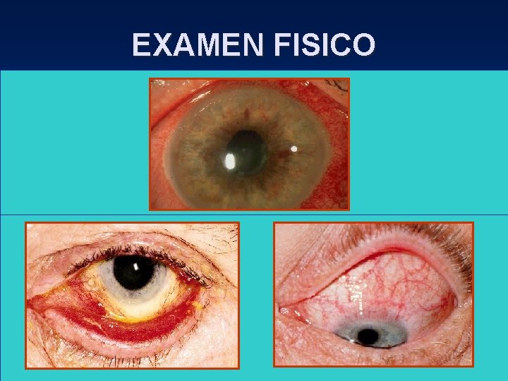 EXAMEN FISICO • Córnea – QPS : Ojo seco, ectropión, entropión. – Micropanus : EXAMEN FISICO • Córnea – QPS : Ojo seco, ectropión, entropión. – Micropanus :