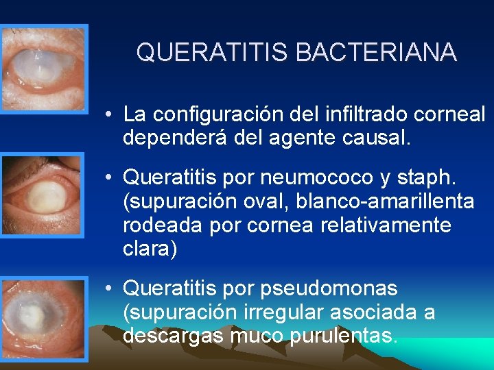 QUERATITIS BACTERIANA • La configuración del infiltrado corneal dependerá del agente causal. • Queratitis QUERATITIS BACTERIANA • La configuración del infiltrado corneal dependerá del agente causal. • Queratitis