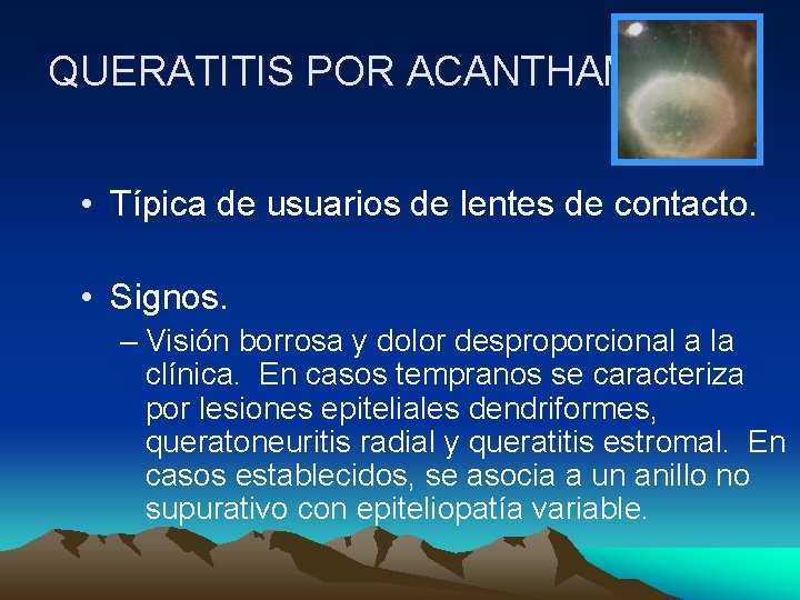 QUERATITIS POR ACANTHAMOEBA • Típica de usuarios de lentes de contacto. • Signos. – QUERATITIS POR ACANTHAMOEBA • Típica de usuarios de lentes de contacto. • Signos. –