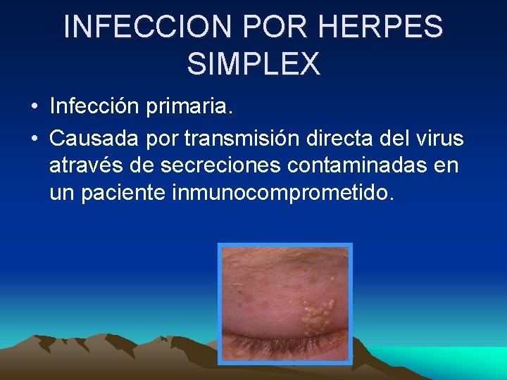 INFECCION POR HERPES SIMPLEX • Infección primaria. • Causada por transmisión directa del virus INFECCION POR HERPES SIMPLEX • Infección primaria. • Causada por transmisión directa del virus