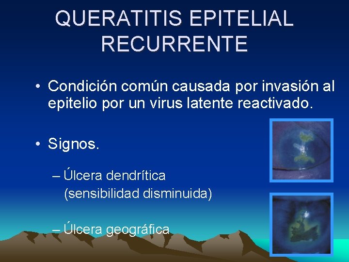 QUERATITIS EPITELIAL RECURRENTE • Condición común causada por invasión al epitelio por un virus QUERATITIS EPITELIAL RECURRENTE • Condición común causada por invasión al epitelio por un virus