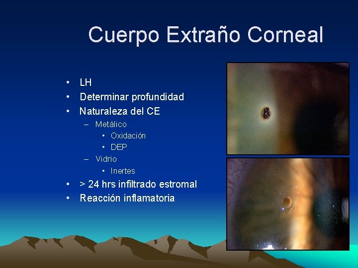Cuerpo Extraño Corneal • LH • Determinar profundidad • Naturaleza del CE – Metálico Cuerpo Extraño Corneal • LH • Determinar profundidad • Naturaleza del CE – Metálico