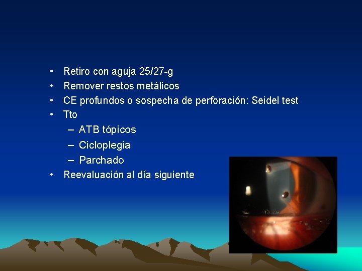 • • Retiro con aguja 25/27 -g Remover restos metálicos CE profundos o • • Retiro con aguja 25/27 -g Remover restos metálicos CE profundos o