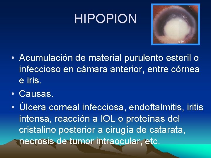 HIPOPION • Acumulación de material purulento esteril o infeccioso en cámara anterior, entre córnea HIPOPION • Acumulación de material purulento esteril o infeccioso en cámara anterior, entre córnea