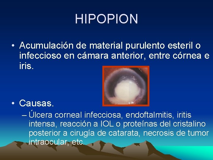 HIPOPION • Acumulación de material purulento esteril o infeccioso en cámara anterior, entre córnea HIPOPION • Acumulación de material purulento esteril o infeccioso en cámara anterior, entre córnea
