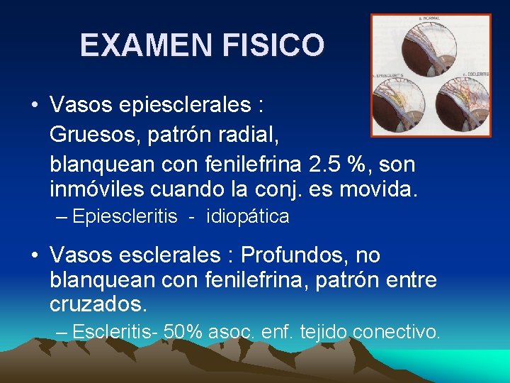 EXAMEN FISICO • Vasos epiesclerales : Gruesos, patrón radial, blanquean con fenilefrina 2. 5 EXAMEN FISICO • Vasos epiesclerales : Gruesos, patrón radial, blanquean con fenilefrina 2. 5