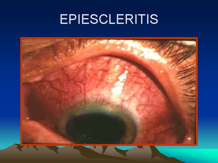 EPIESCLERITIS EPIESCLERITIS
