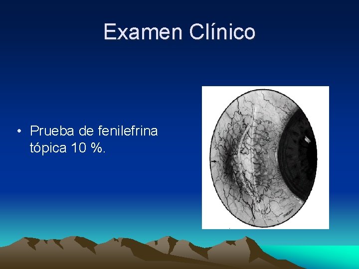 Examen Clínico • Prueba de fenilefrina tópica 10 %. Examen Clínico • Prueba de fenilefrina tópica 10 %.