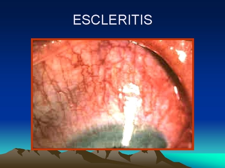 ESCLERITIS ESCLERITIS