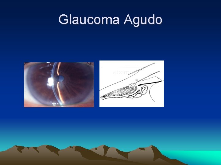 Glaucoma Agudo Glaucoma Agudo