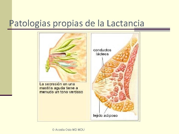 Patologias propias de la Lactancia G Acosta Osio MD MDU 