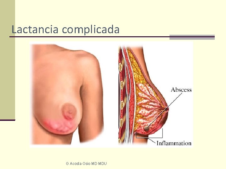 Lactancia complicada G Acosta Osio MD MDU 