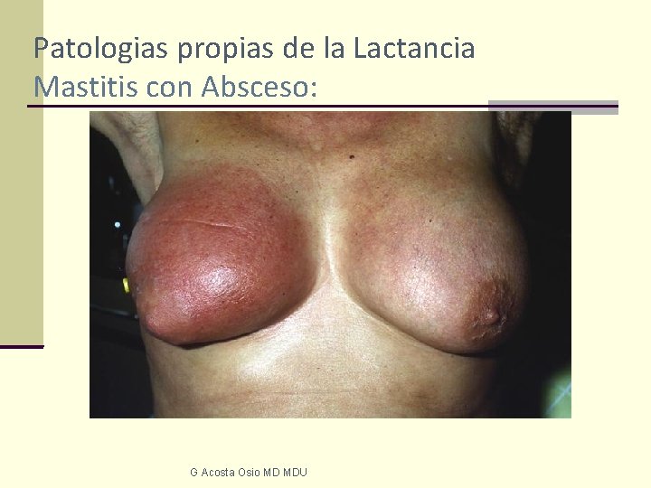 Patologias propias de la Lactancia Mastitis con Absceso: G Acosta Osio MD MDU 