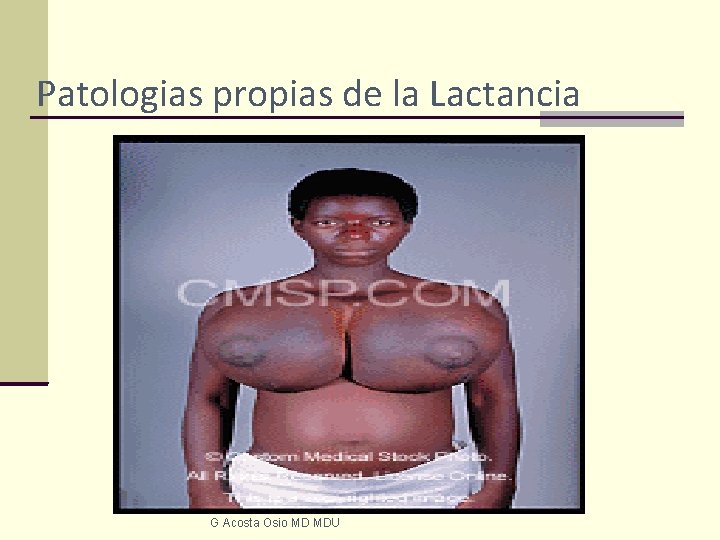 Patologias propias de la Lactancia G Acosta Osio MD MDU 