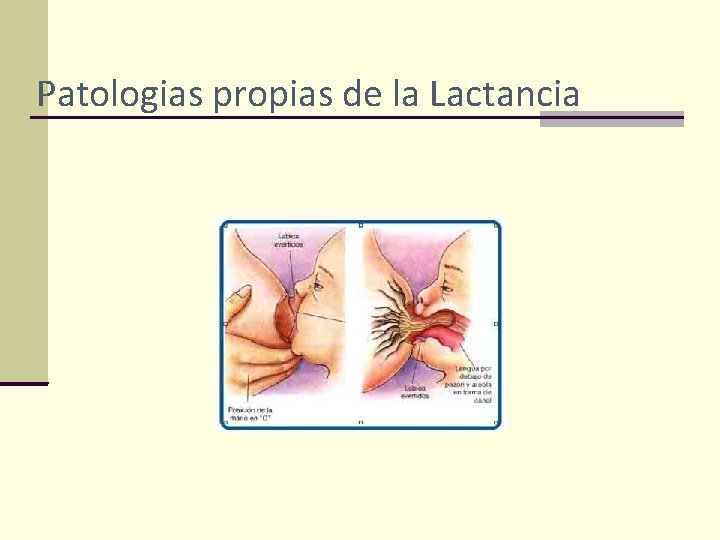 Patologias propias de la Lactancia 