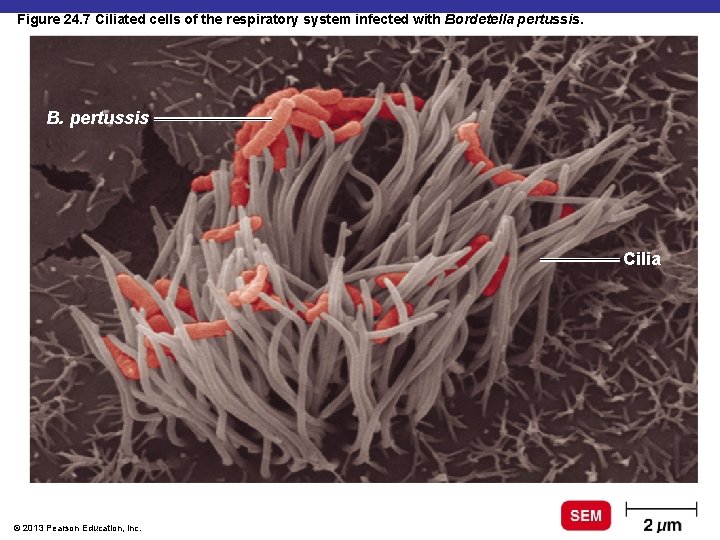Figure 24. 7 Ciliated cells of the respiratory system infected with Bordetella pertussis. B.