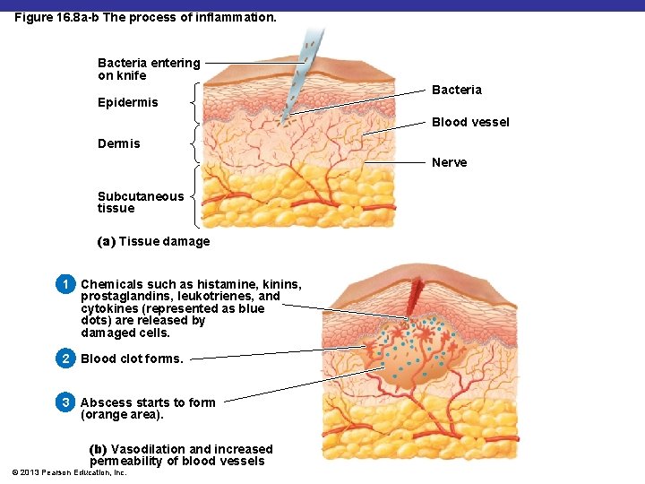 Figure 16. 8 a-b The process of inflammation. Bacteria entering on knife Epidermis Bacteria