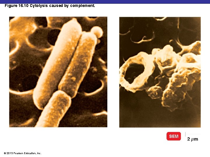 Figure 16. 10 Cytolysis caused by complement. Insert Fig 16. 10 © 2013 Pearson