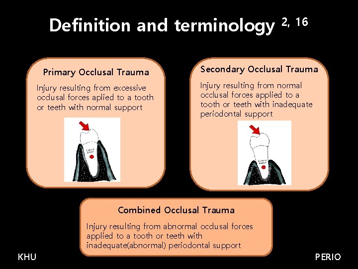 Definition and terminology Primary Occlusal Trauma Injury resulting from excessive occlusal forces aplied to