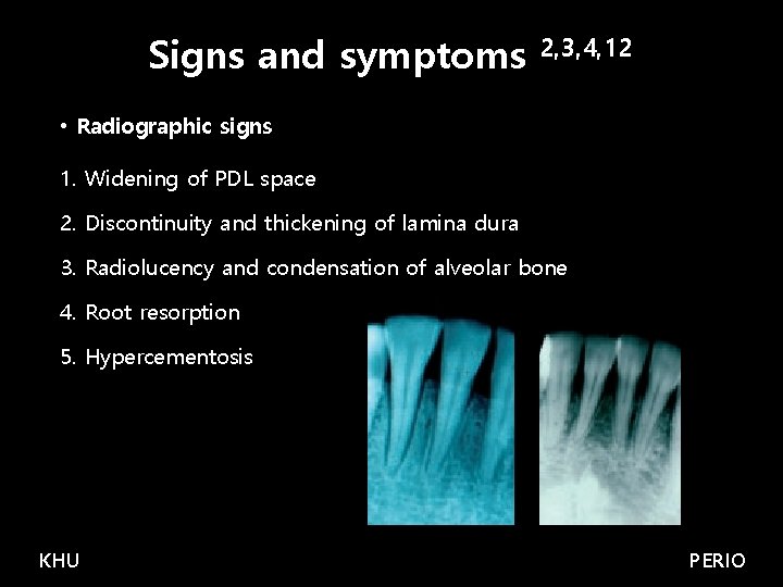 Signs and symptoms 2, 3, 4, 12 • Radiographic signs 1. Widening of PDL