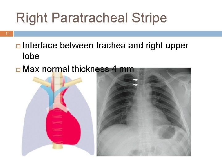 Right Paratracheal Stripe 11 Interface between trachea and right upper lobe ¨ Max normal