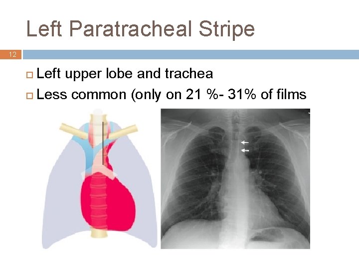Left Paratracheal Stripe 12 Left upper lobe and trachea ¨ Less common (only on