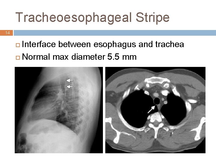 Tracheoesophageal Stripe 14 Interface between esophagus and trachea ¨ Normal max diameter 5. 5