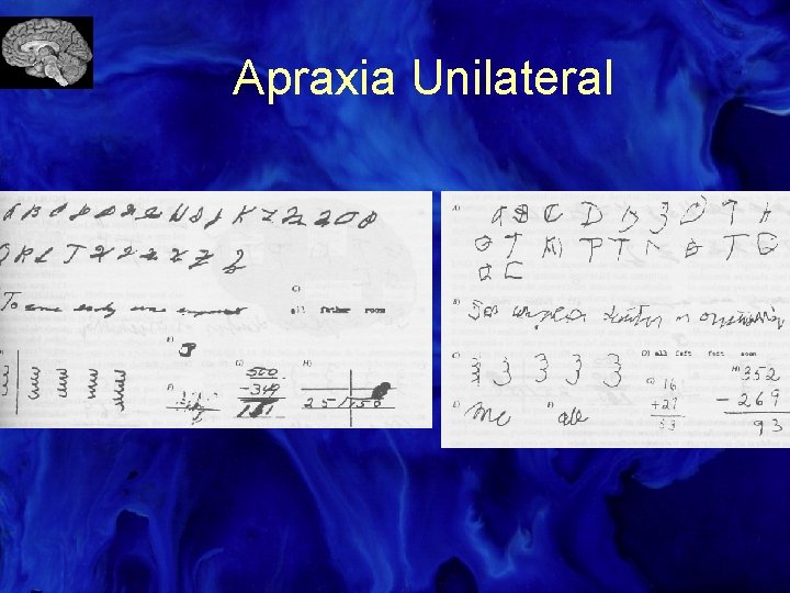 Apraxia Unilateral 