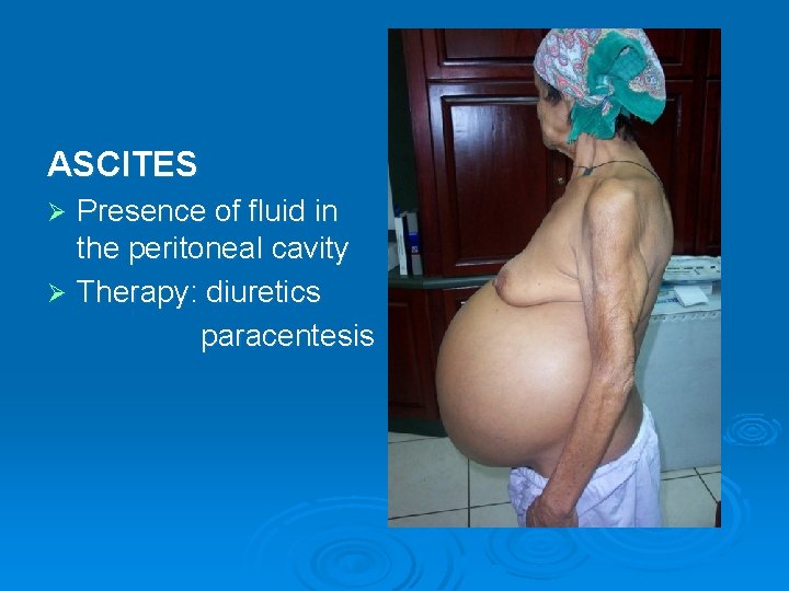 ASCITES Presence of fluid in the peritoneal cavity Ø Therapy: diuretics paracentesis Ø 
