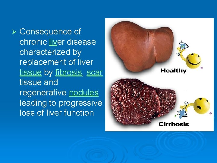 Ø Consequence of chronic liver disease characterized by replacement of liver tissue by fibrosis,