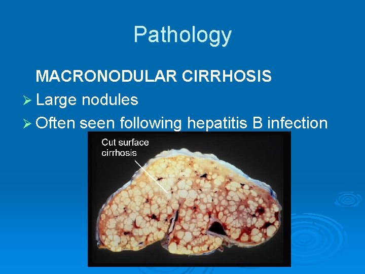 Pathology MACRONODULAR CIRRHOSIS Ø Large nodules Ø Often seen following hepatitis B infection 
