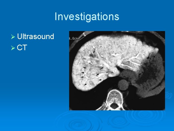 Investigations Ø Ultrasound Ø CT 