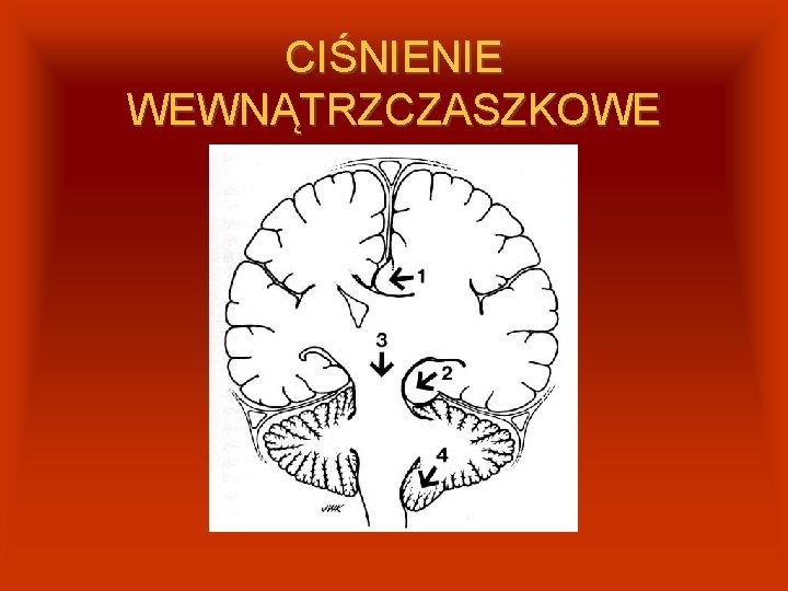 CIŚNIENIE WEWNĄTRZCZASZKOWE 