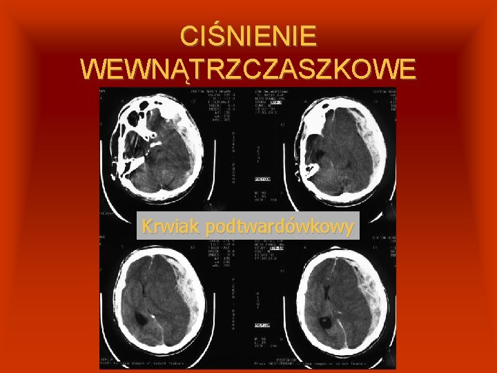 CIŚNIENIE WEWNĄTRZCZASZKOWE Krwiak podtwardówkowy 