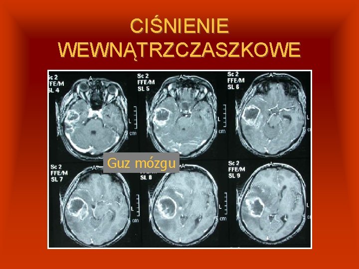 CIŚNIENIE WEWNĄTRZCZASZKOWE Guz mózgu 