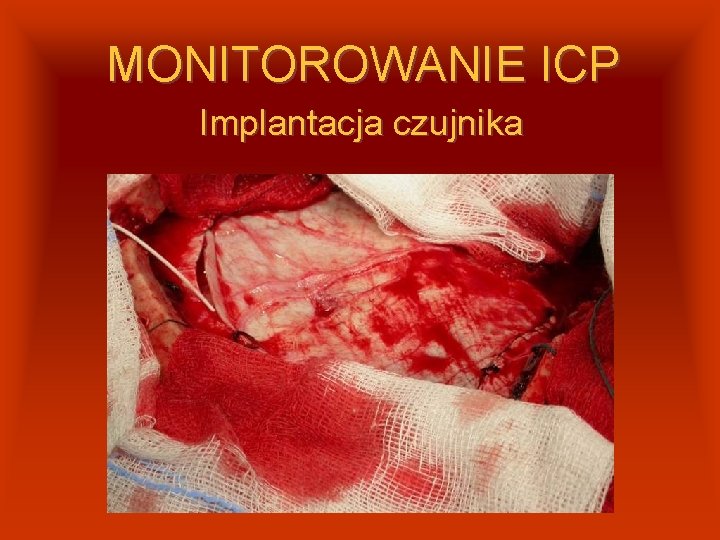 MONITOROWANIE ICP Implantacja czujnika 