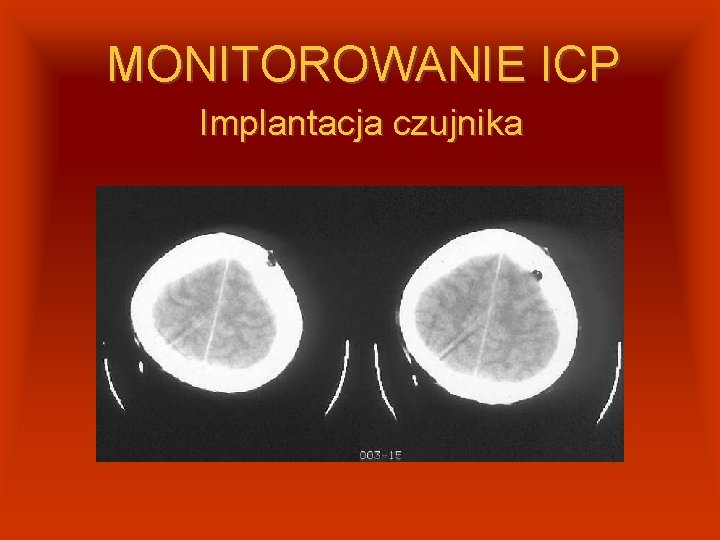 MONITOROWANIE ICP Implantacja czujnika 