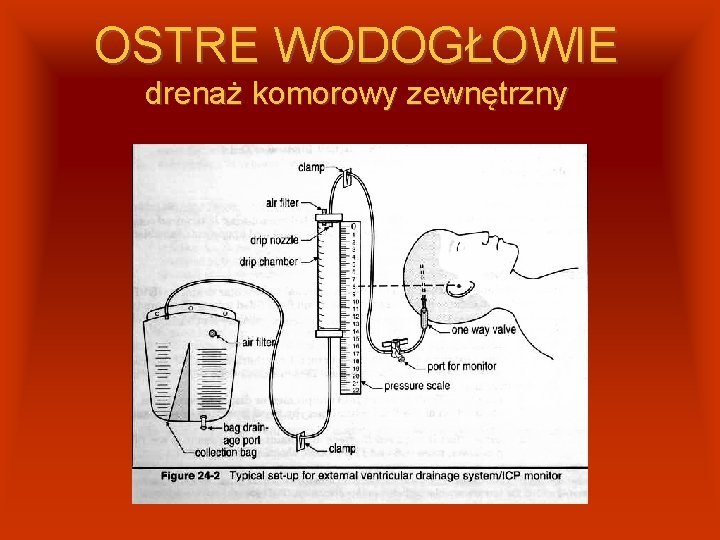 OSTRE WODOGŁOWIE drenaż komorowy zewnętrzny 